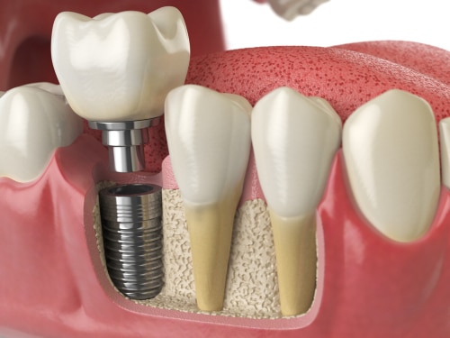 benefits of dental implants